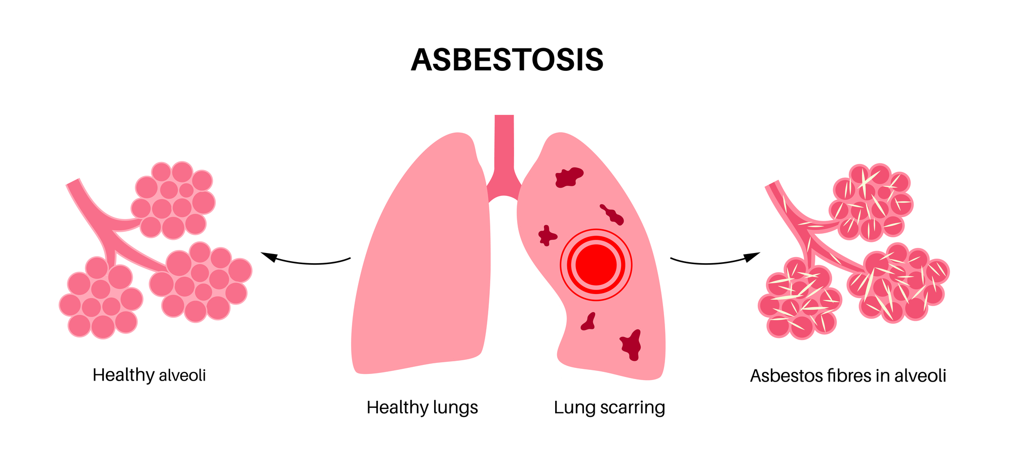 Asbestosis anatomical poster. Lung disease concept, asbestos fibers. Lung tissue scarring and shortness of breath, pain in chest. Breathing problem, illness of respiratory system vector illustration.